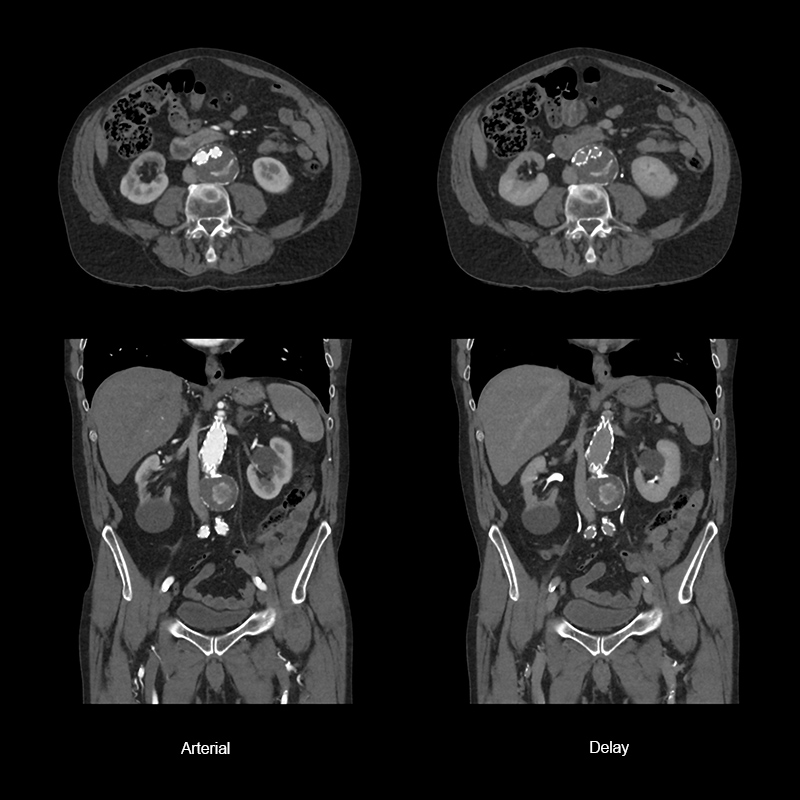 Aquilion ONE / GENESIS Edition AiCE, Aortic Stent Graft