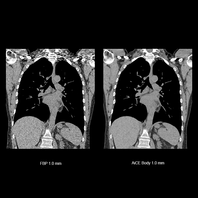 Aquilion ONE / GENESIS Edition AiCE, Chest CT