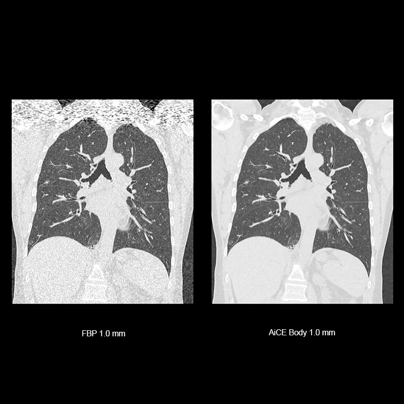 Aquilion ONE / GENESIS Edition AiCE, Chest CT