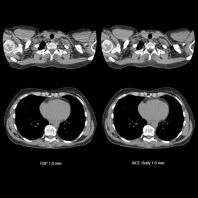 Aquilion ONE / GENESIS Edition AiCE, Chest CT