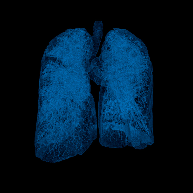 Aquilion ONE / GENESIS Edition AiCE, Lung Emphysem