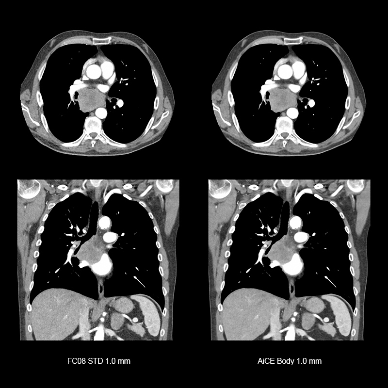 Aquilion ONE / GENESIS Edition AiCE, Lung Masses