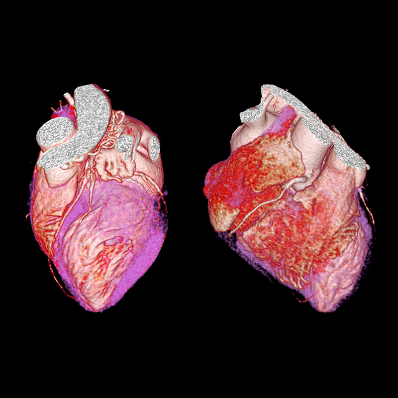 Aquilion ONE / GENESIS Edition AiCE, Cardiac CTA
