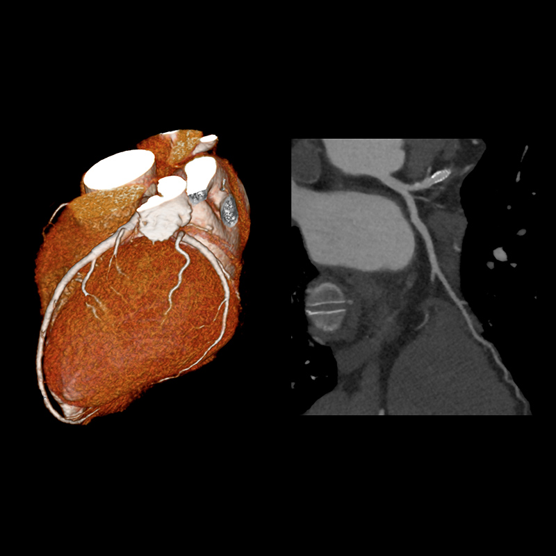 Aquilion ONE / GENESIS Edition AiCE LAD Stent