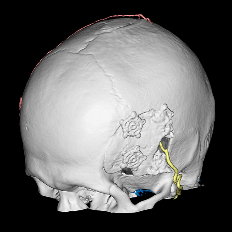 Aquilion ONE / GENESIS Edition 4DCT DSA, Cerebral Bypass