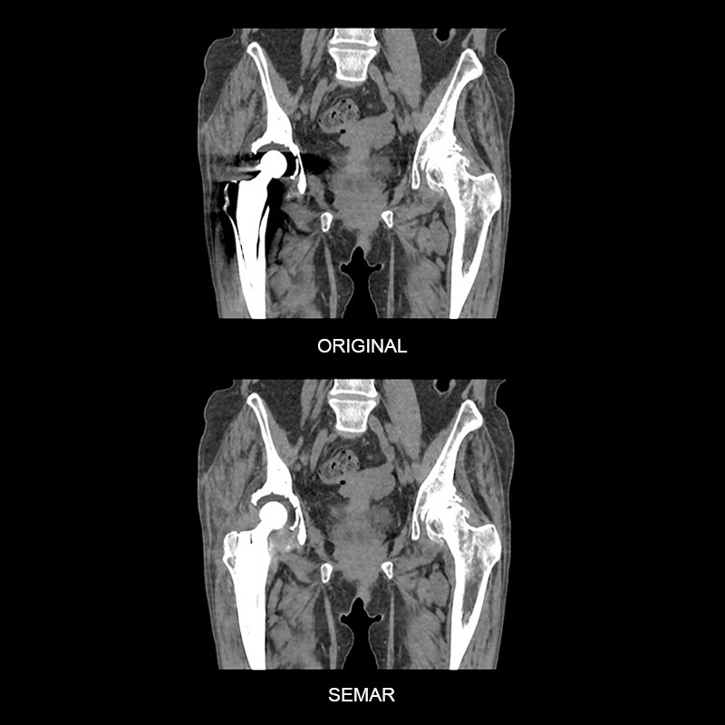Aquilion ONE / GENESIS Edition SEMAR, Right Hip Replacement