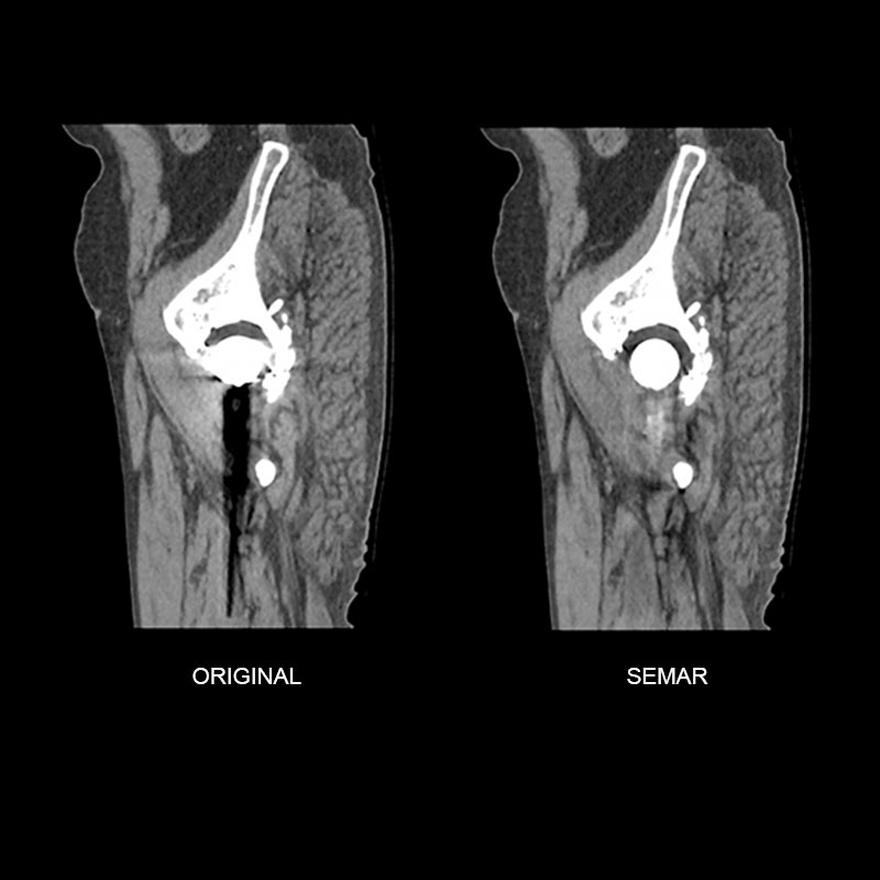 Aquilion ONE / GENESIS Edition SEMAR, Right Hip Replacement