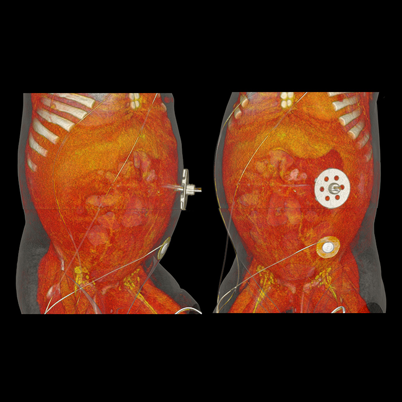Aquilion ONE / GENESIS Edition AiCE, Abdomen and Pelvis