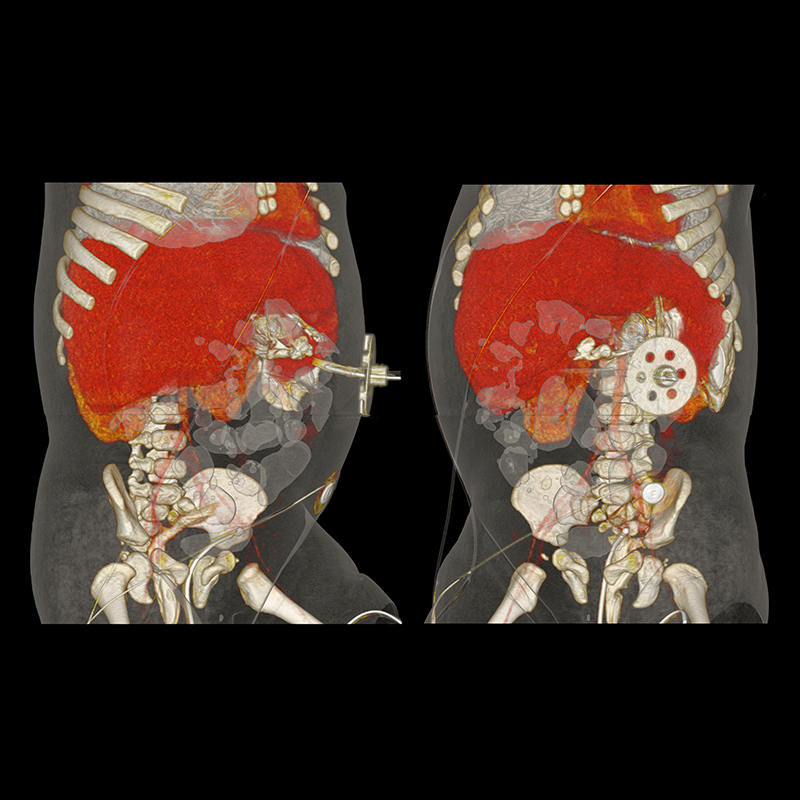Aquilion ONE / GENESIS Edition AiCE, Abdomen and Pelvis