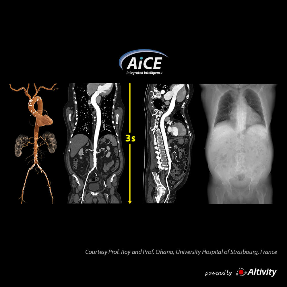 Aquilion ONE / INSIGHT Edition Aorta CTA – Turbo Helical