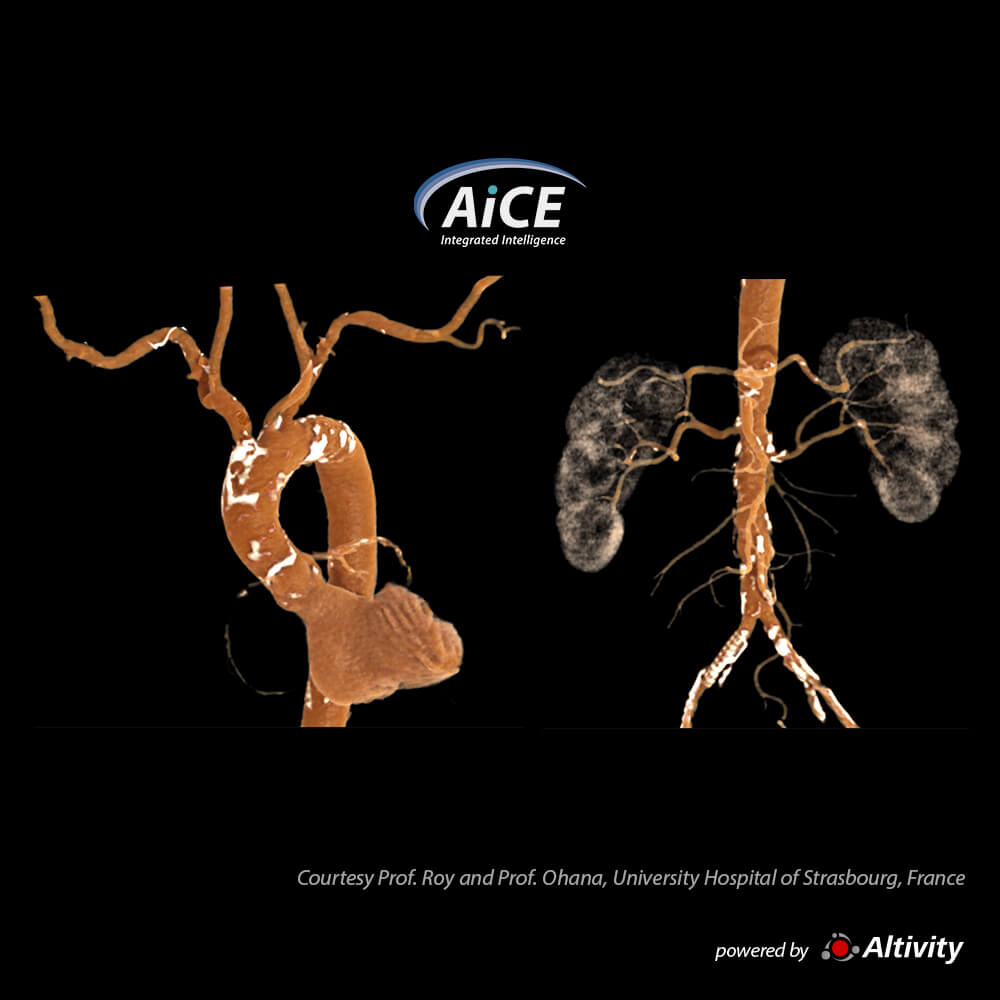 Aquilion ONE / INSIGHT Edition Aorta CTA – Turbo Helical