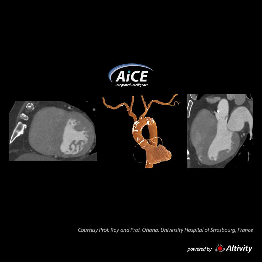 Aquilion ONE / INSIGHT Edition Aorta CTA – Turbo Helical