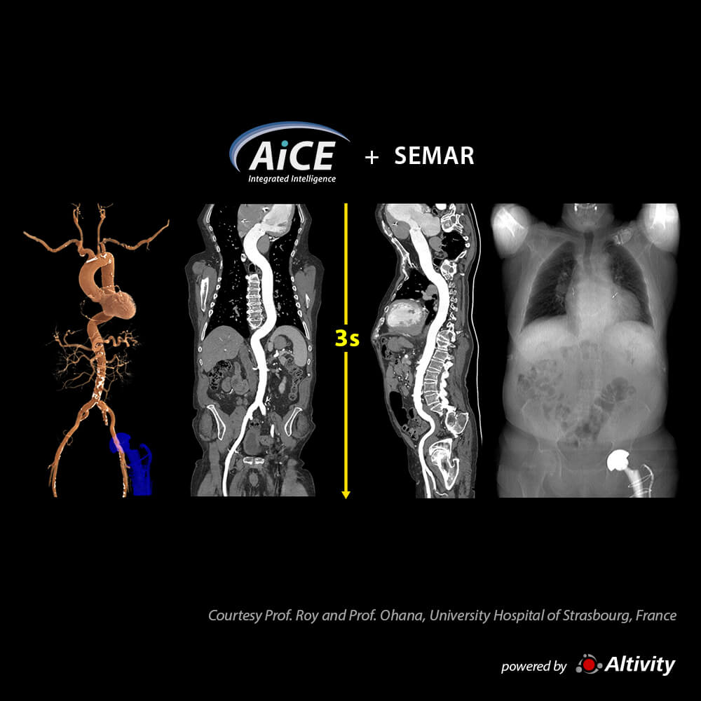 Aquilion ONE / INSIGHT Edition Aorta CTA – Turbo Helical+SEMAR