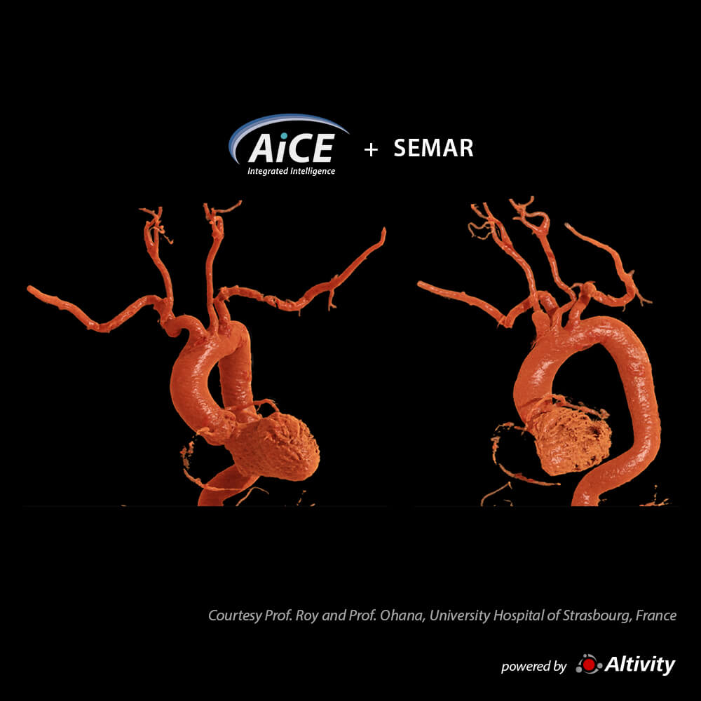 Aquilion ONE / INSIGHT Edition Aorta CTA – Turbo Helical+SEMAR