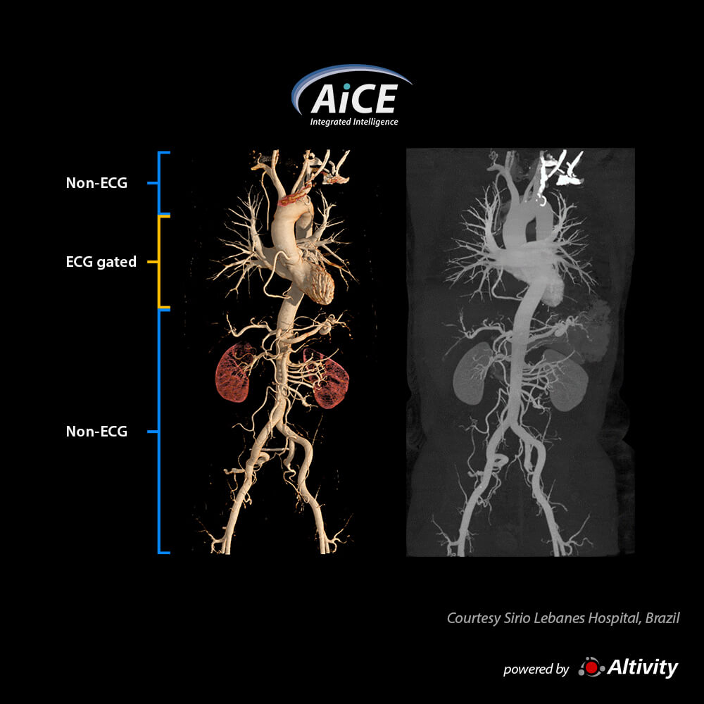 Aquilion ONE / INSIGHT Edition Aorta CTA using vHP
