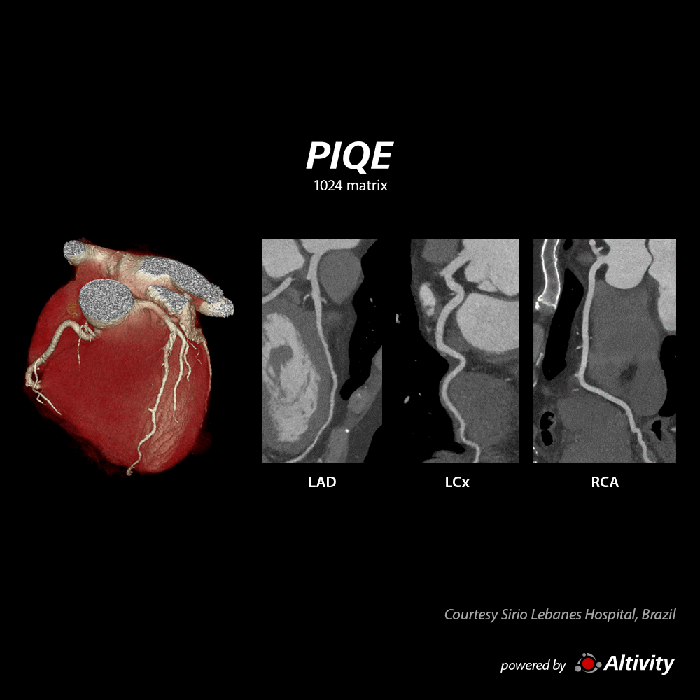 Aquilion ONE / INSIGHT Edition Aorta CTA using vHP