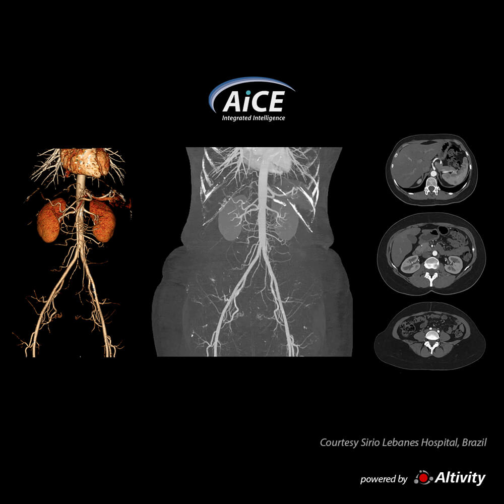 Aquilion ONE / INSIGHT Edition Aorta CTA with SCT