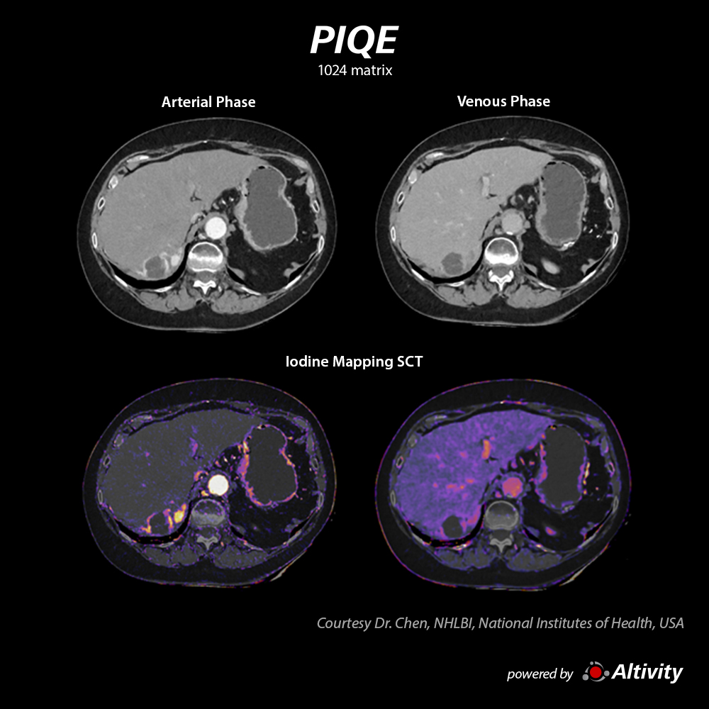 Aquilion ONE / INSIGHT Edition Liver lesion with iodine mapping SCT
