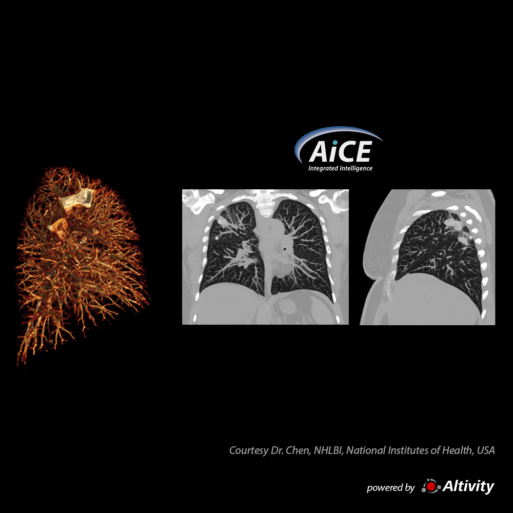 Aquilion ONE / INSIGHT Edition Pulmonary Cryptococcus Infection