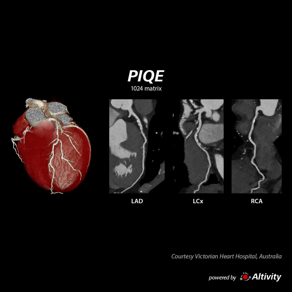 Aquilion ONE / INSIGHT Edition Cardiac