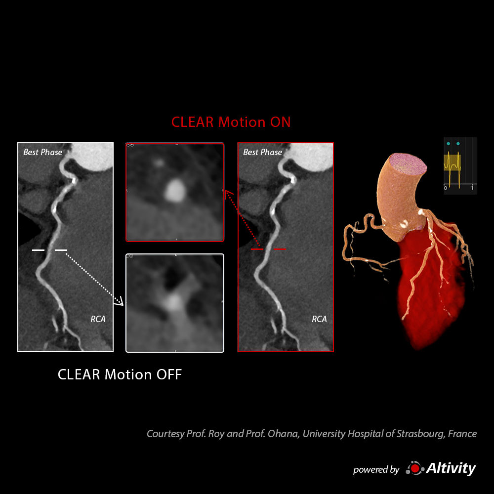 Cardiac CTA with High Heart Rate: 175 BPM