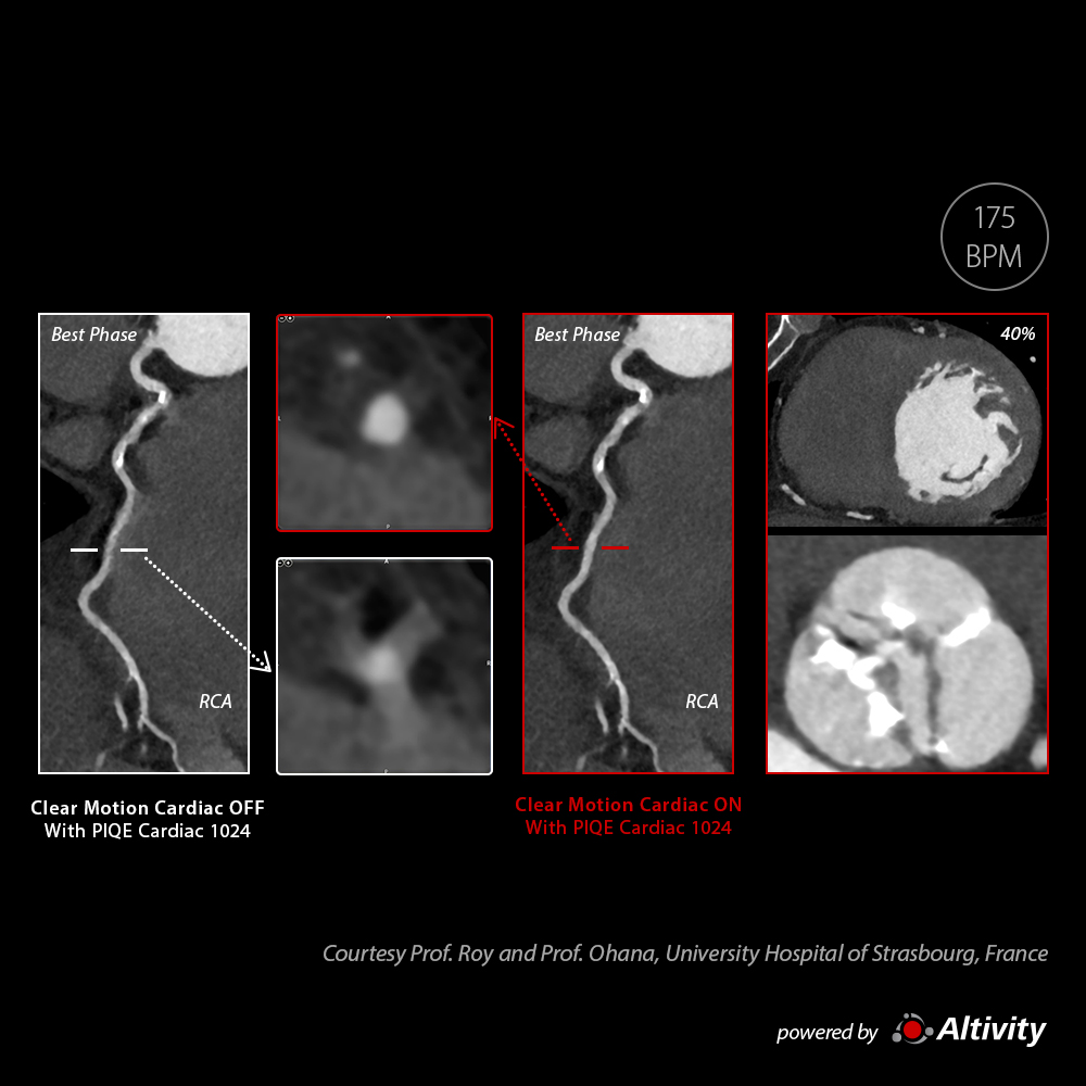 Pre-TAVR with CLEAR Motion Cardiac