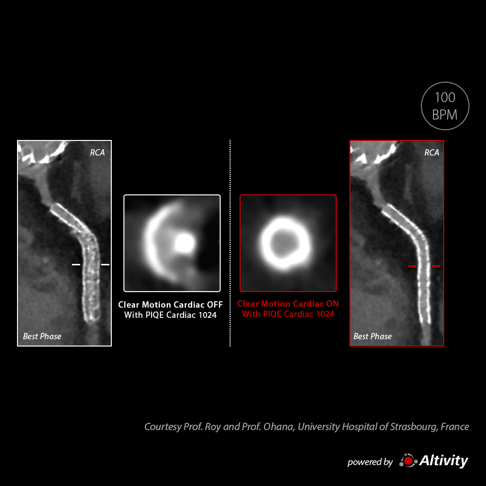 Stent with CLEAR Motion Cardiac