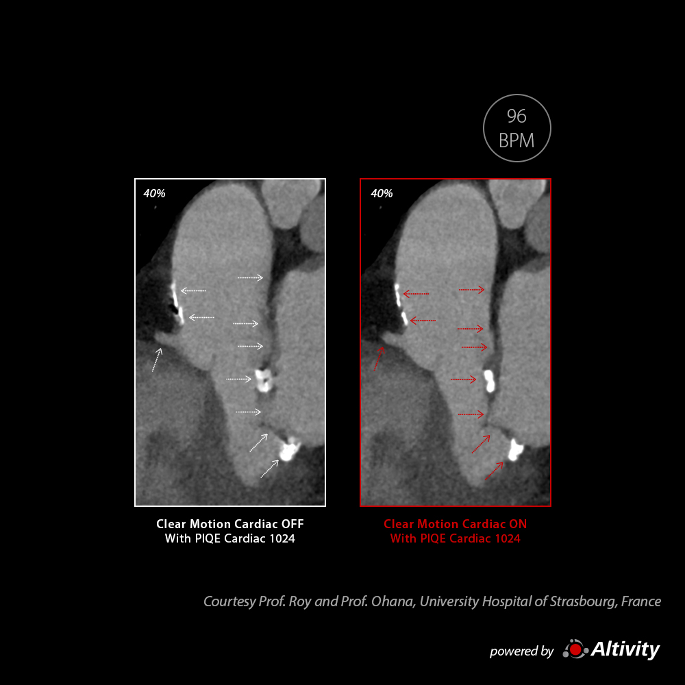 Calcified Aortic Valve with CLEAR Motion Cardiac