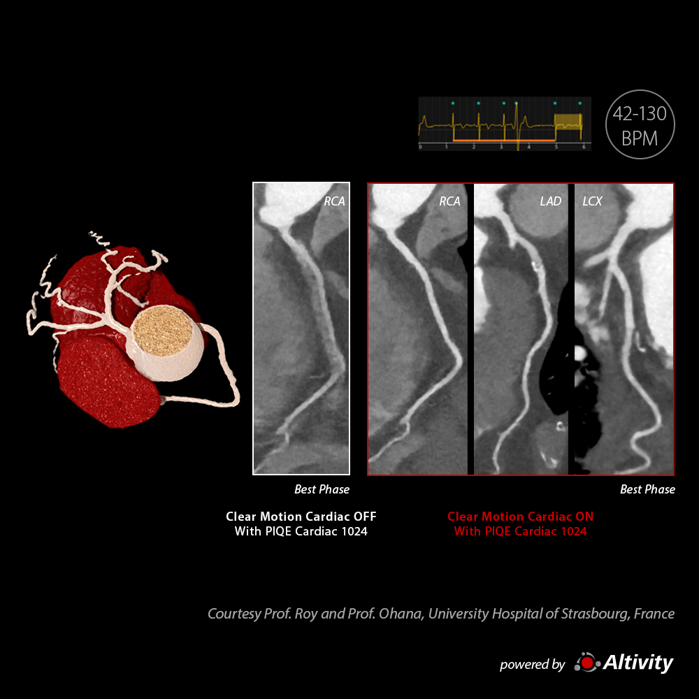 Arrhythmia with CLEAR Motion Cardiac