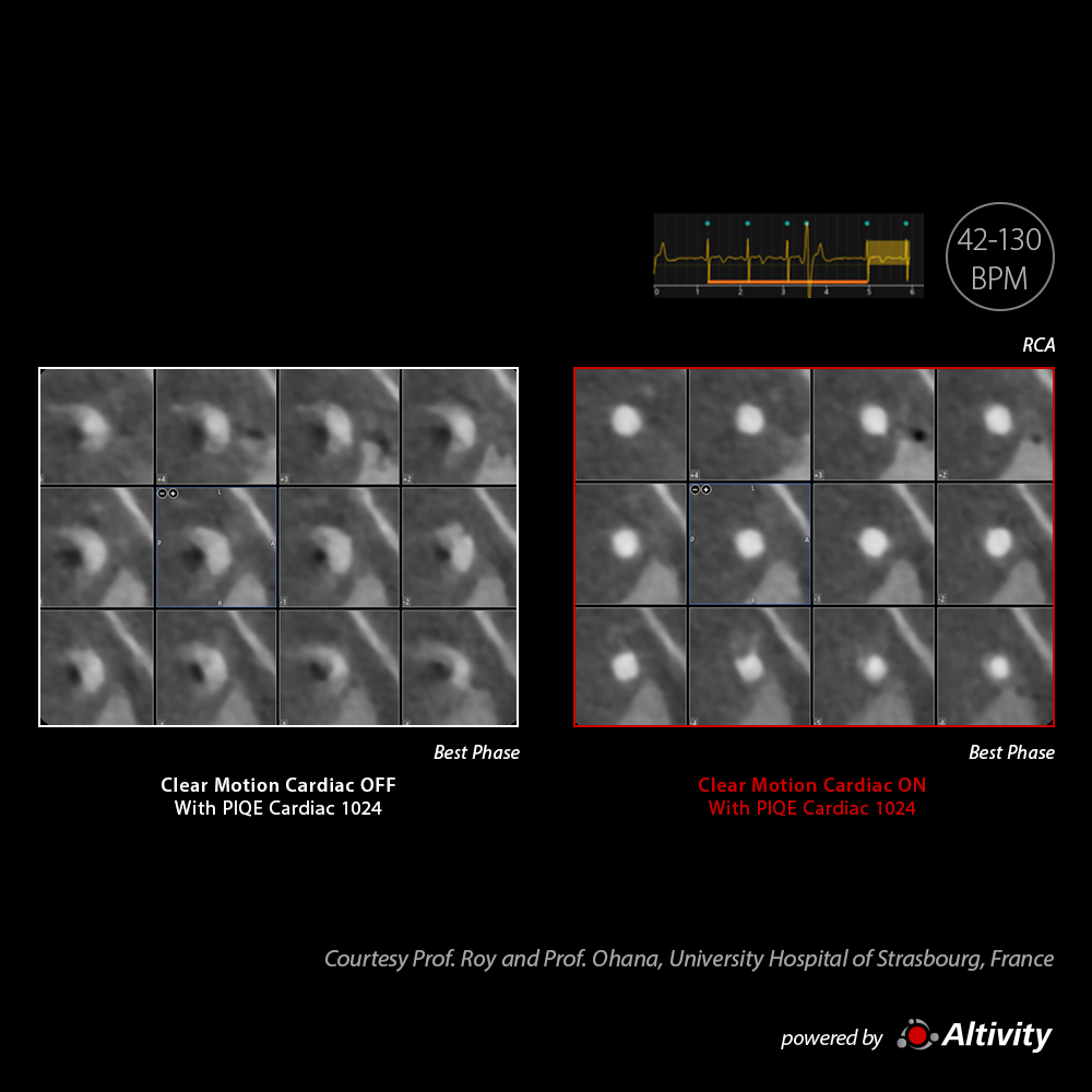 Arrhythmia with CLEAR Motion Cardiac