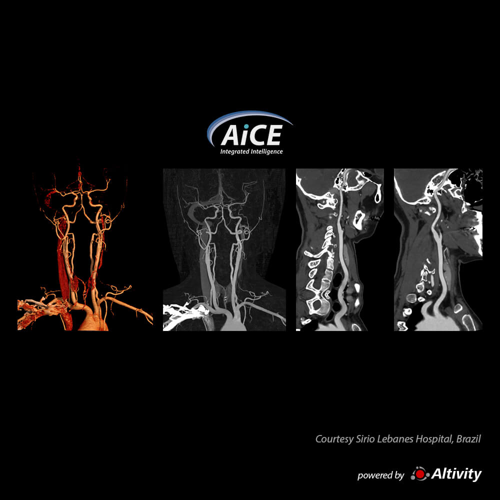 Aquilion ONE / INSIGHT Edition Carotid CTA with SCT