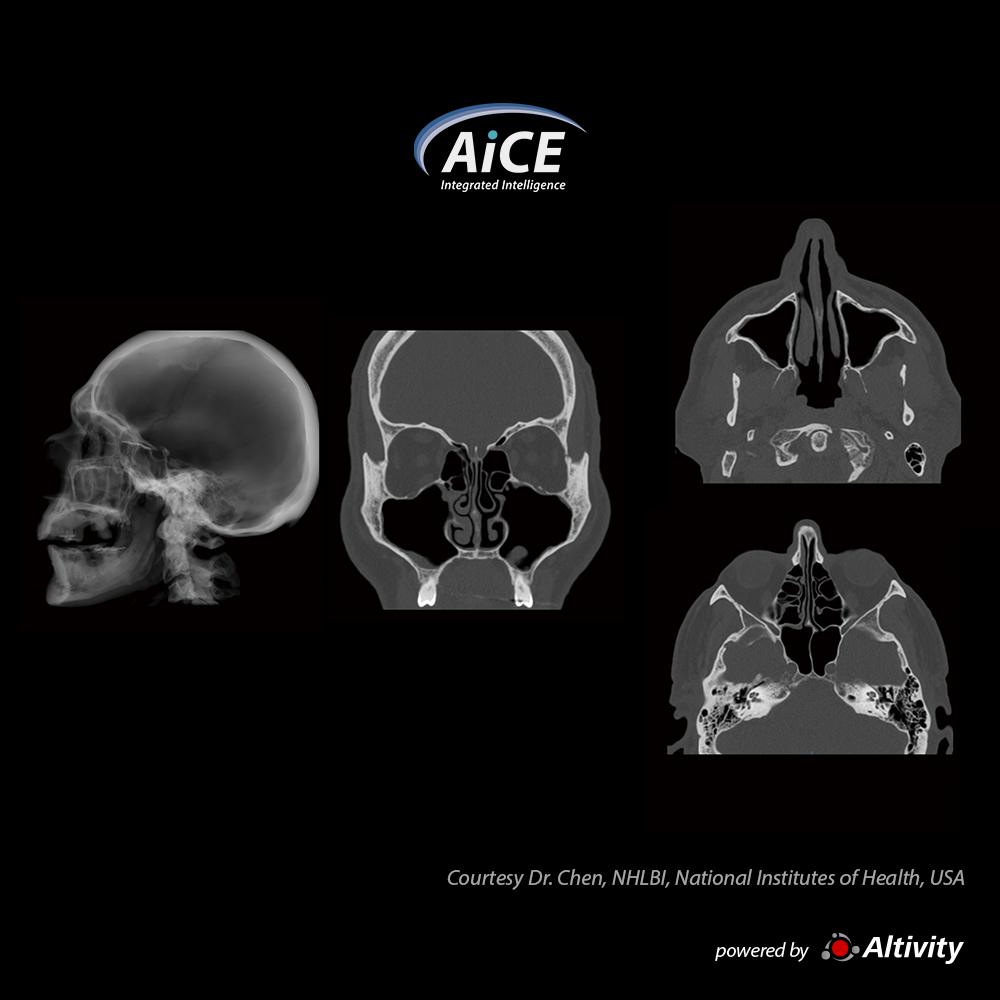 Aquilion ONE / INSIGHT Edition Sinuses