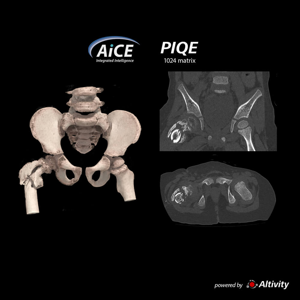 Aquilion ONE / INSIGHT Edition Pelvis Fracture