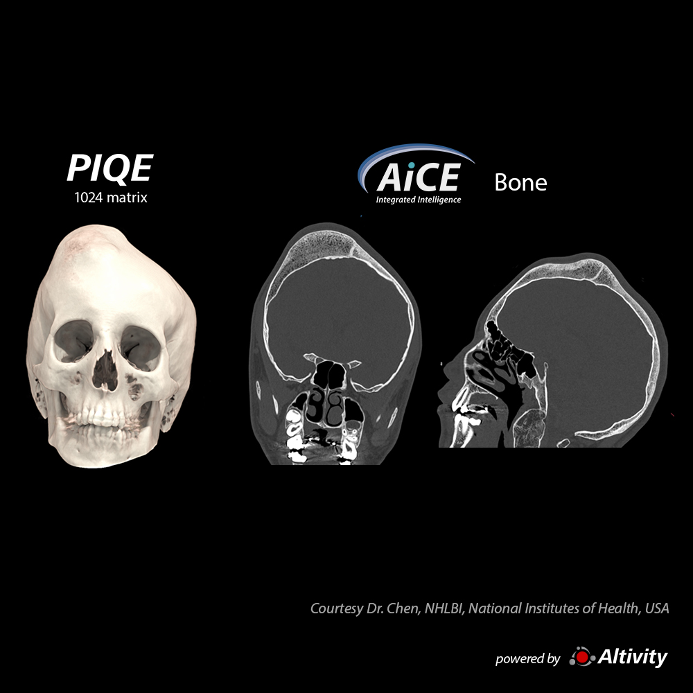 Aquilion ONE / INSIGHT Edition Skull 14-year-old