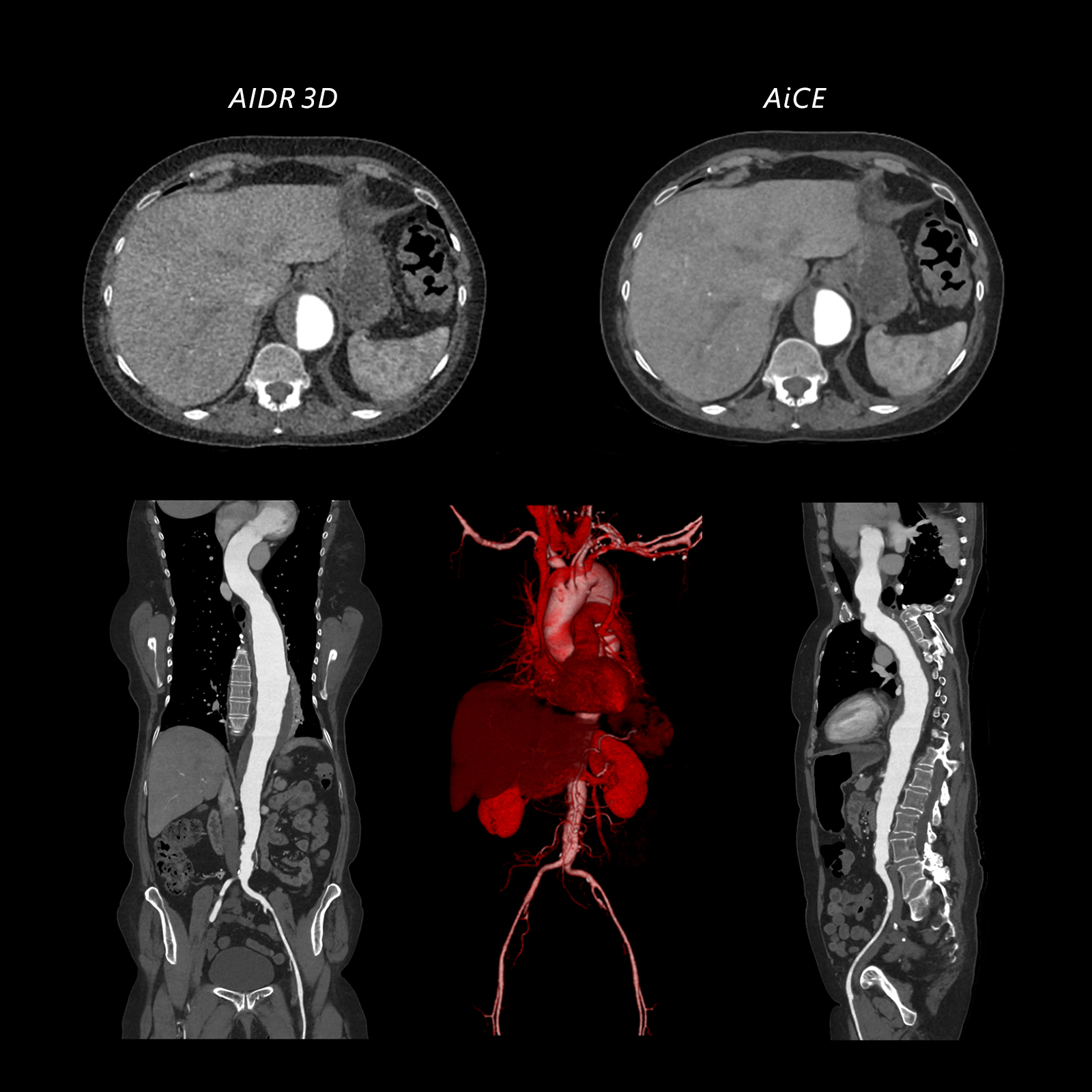Aquilion ONE / PRISM Edition Aorta Mural Thrombosis, AiCE