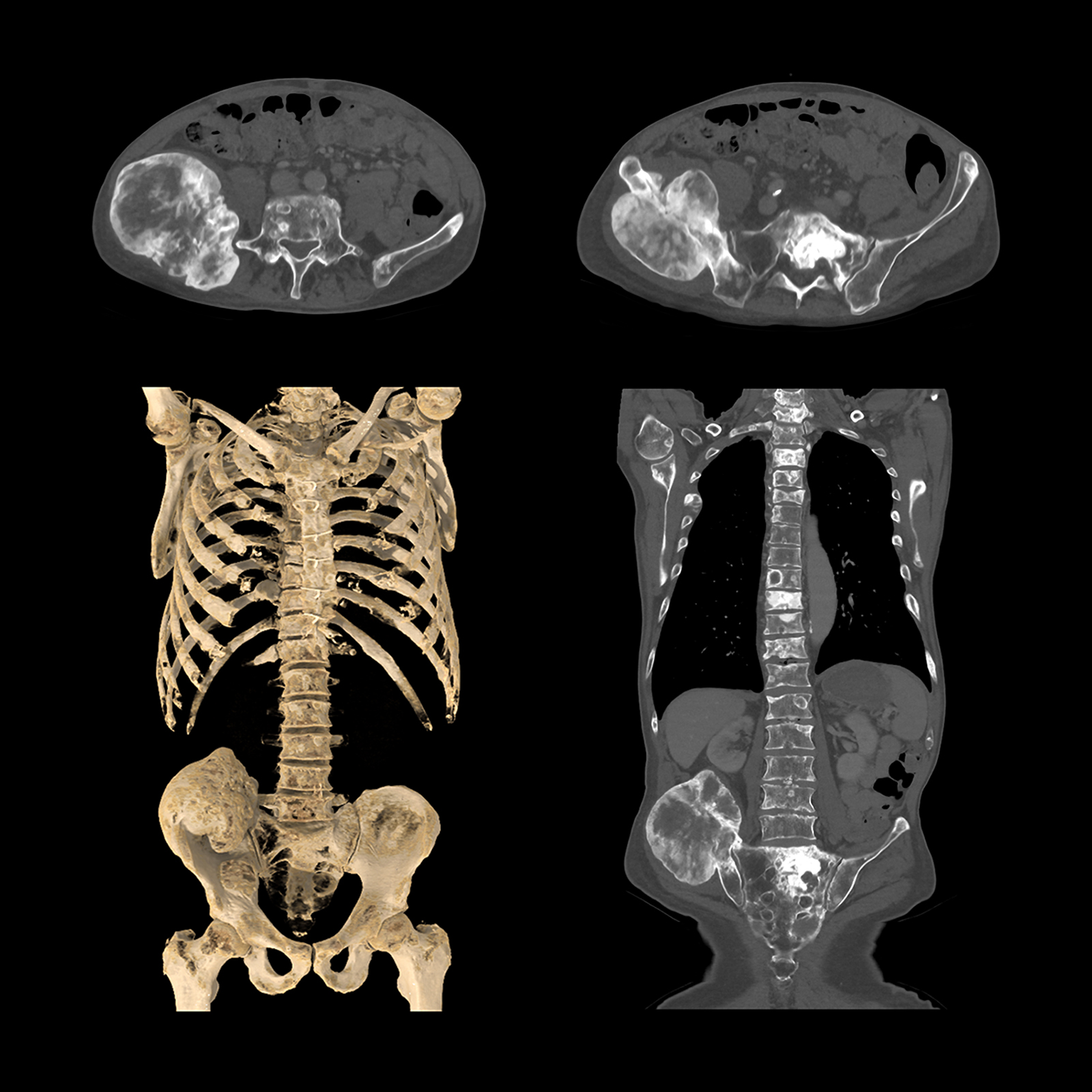 Aquilion ONE / PRISM Edition Bone Mass, AiCE