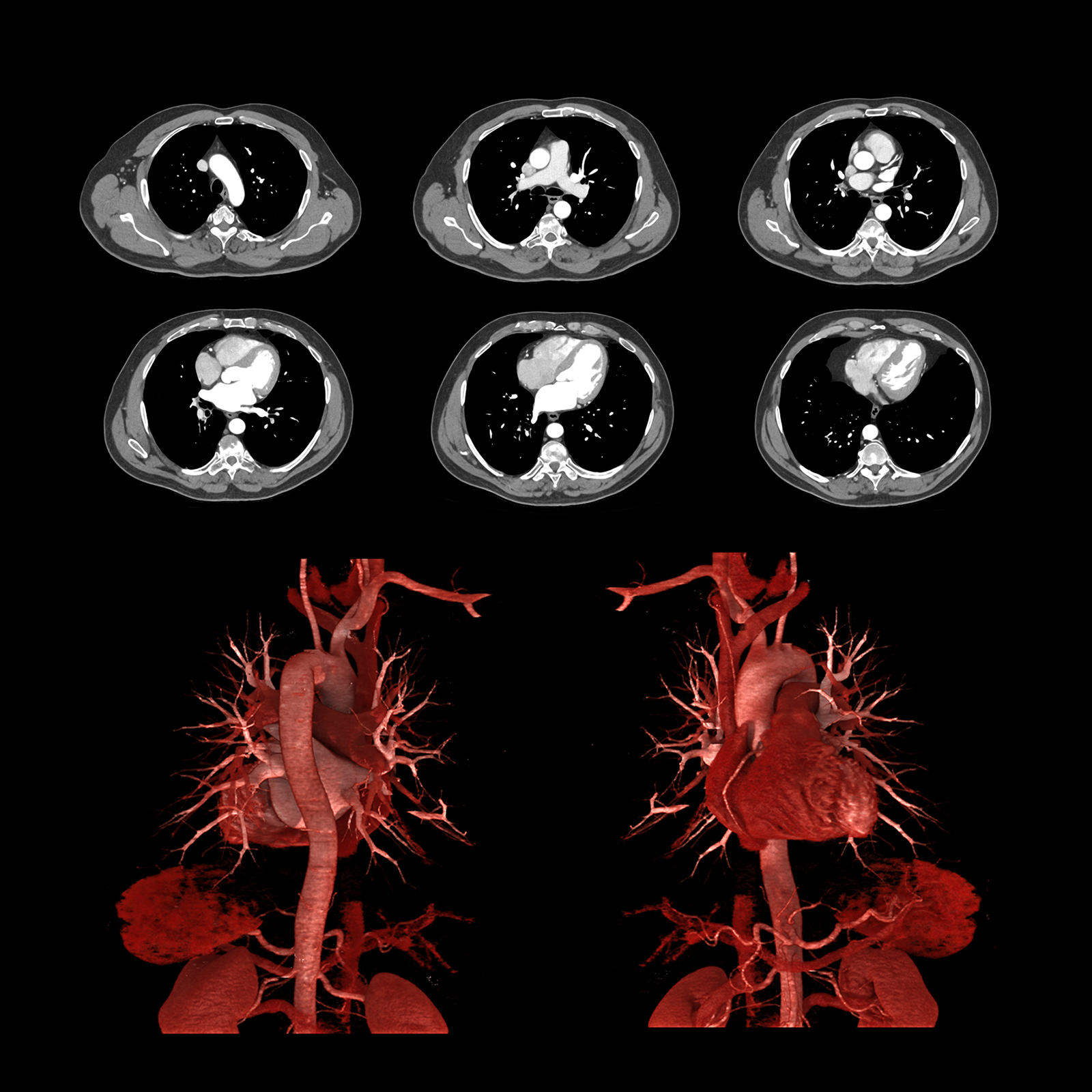 Chest Pain Assessment, Gated, AiCE