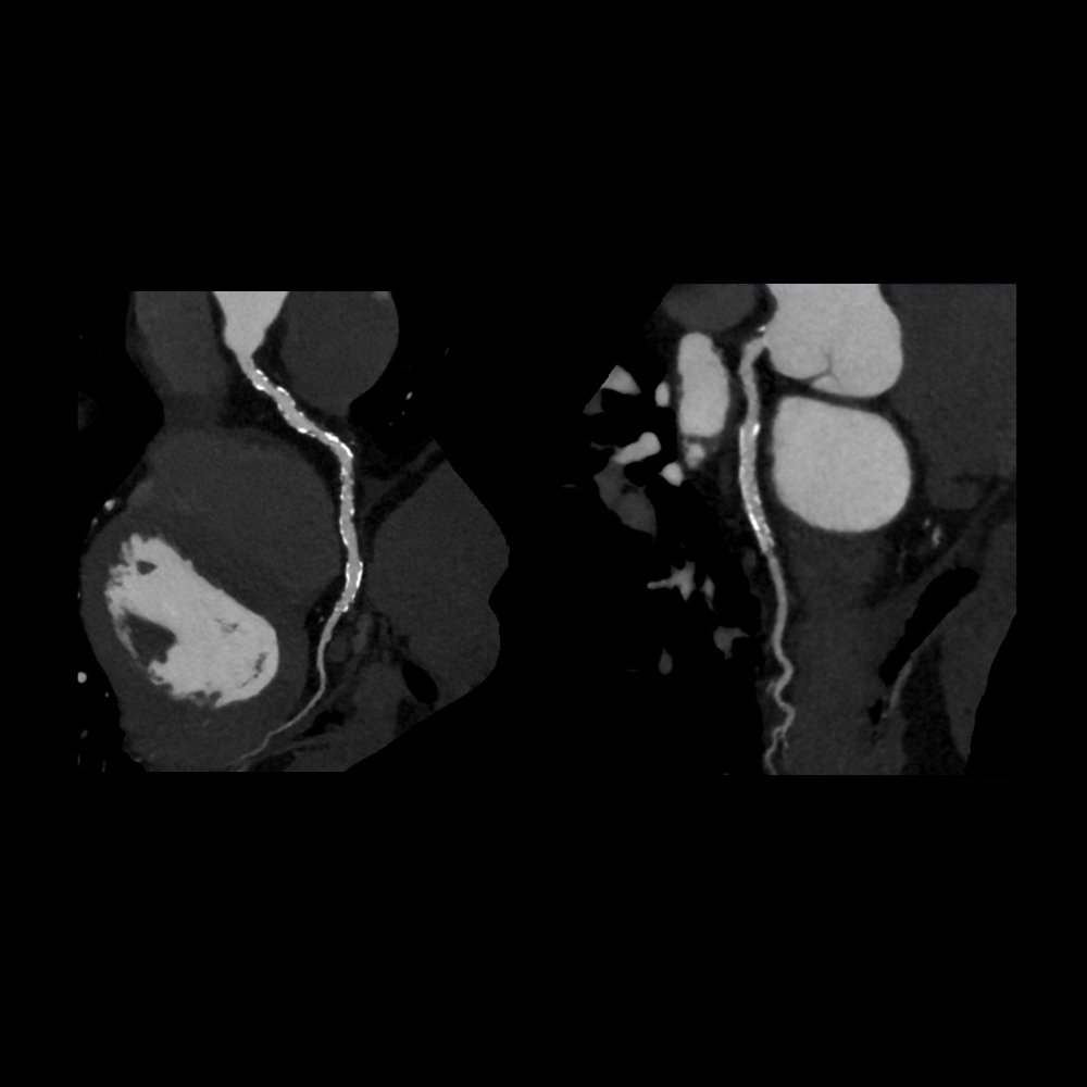 Cardiac CTA, 0.96 mSv, PIQE