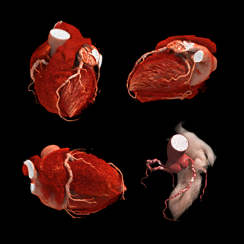 Cardiac CTA, 0.96 mSv, PIQE