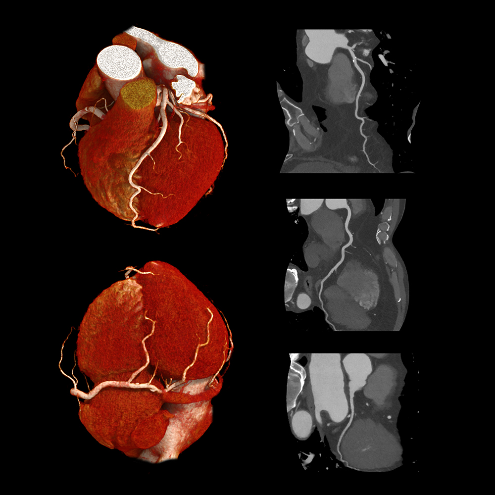 Cardiac CTA, PIQE