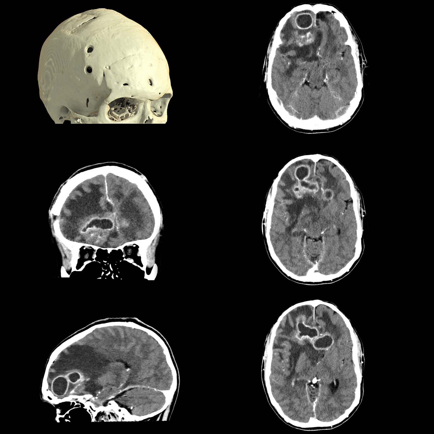 Aquilion ONE / PRISM Edition Brain Abscesses, AiCE