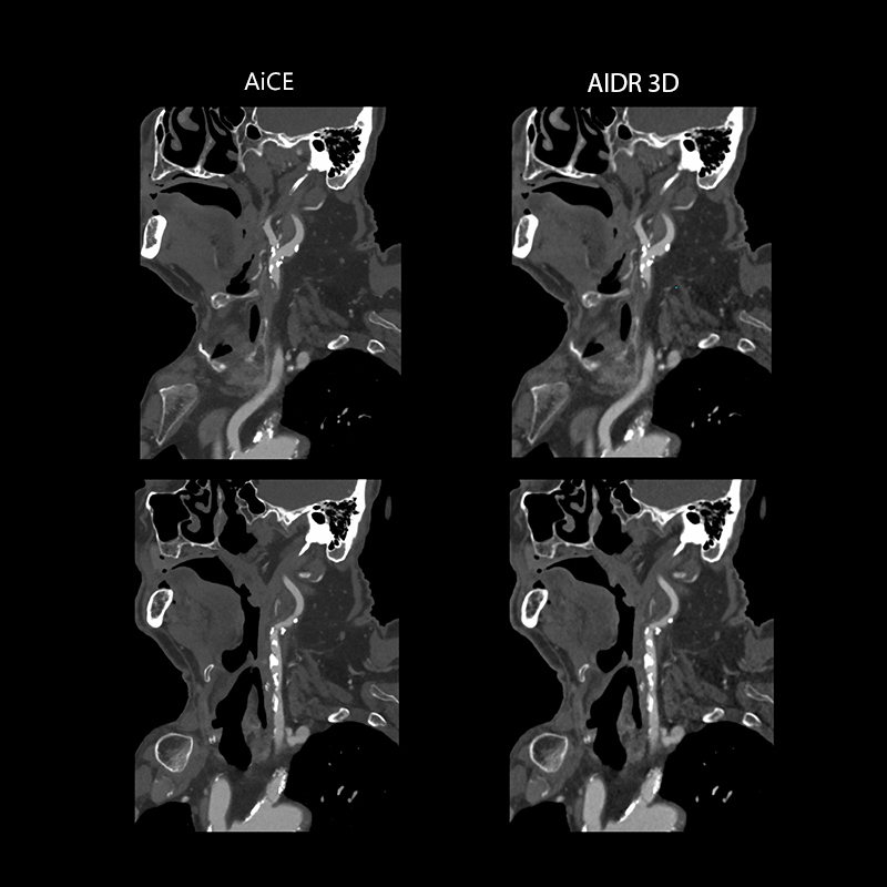Aquilion ONE / PRISM Edition Carotid CTA with Plaque, AiCE