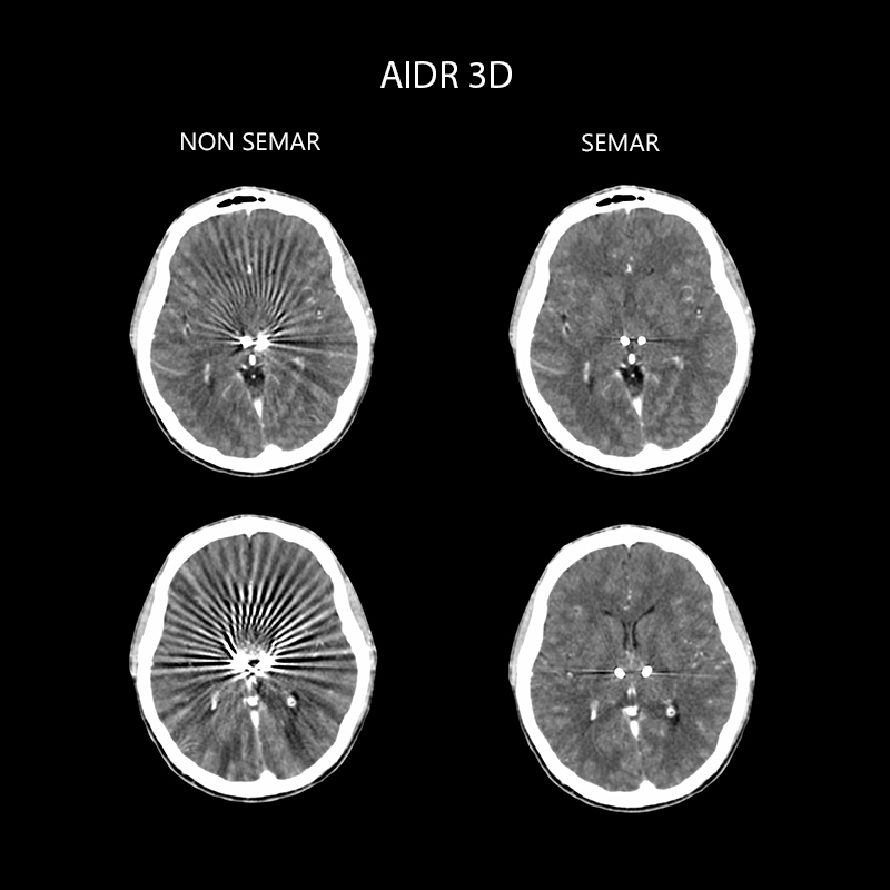 Aquilion ONE / PRISM Edition Deep Brain Stimulator, SEMAR, AiCE LCD