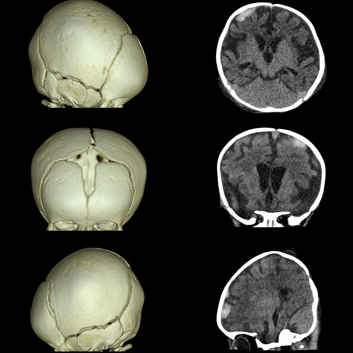 Aquilion ONE / PRISM Edition Brain Subdural Hematoma, Volume