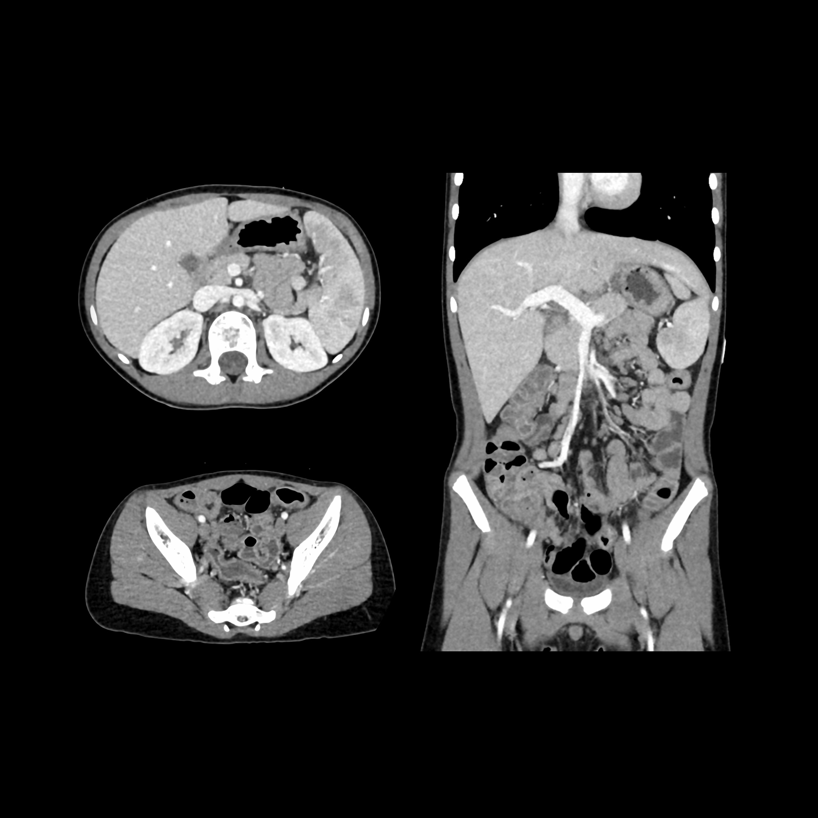 Aquilion ONE / PRISM Edition Abdomen Pelvis 6-year-old, AiCE