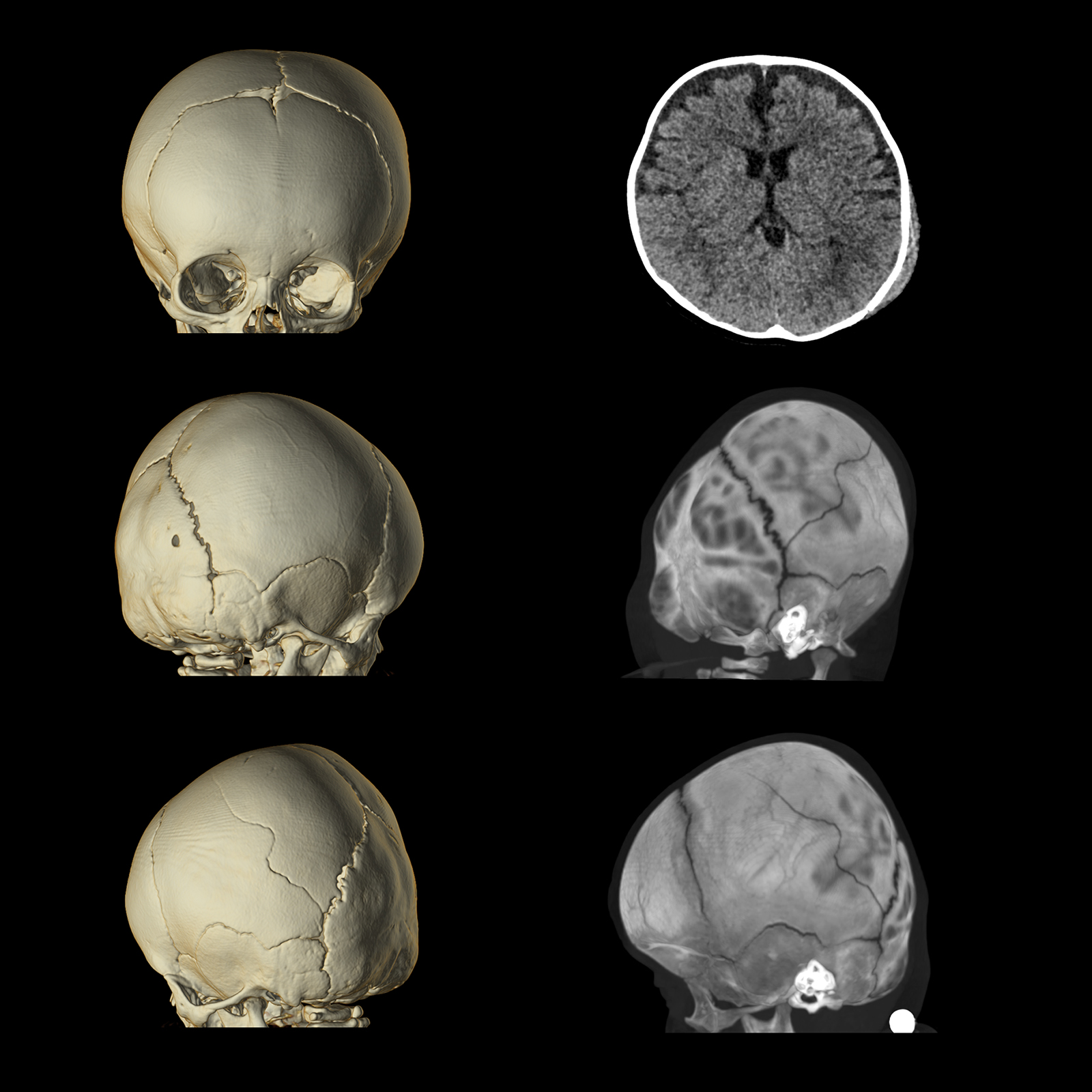 Aquilion ONE / PRISM Edition Brain Skull Fracture, Volume
