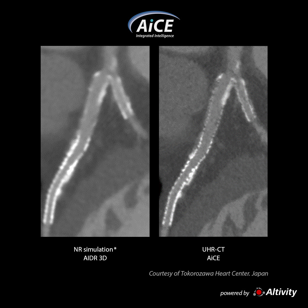 Aquilion Precision Cardiac