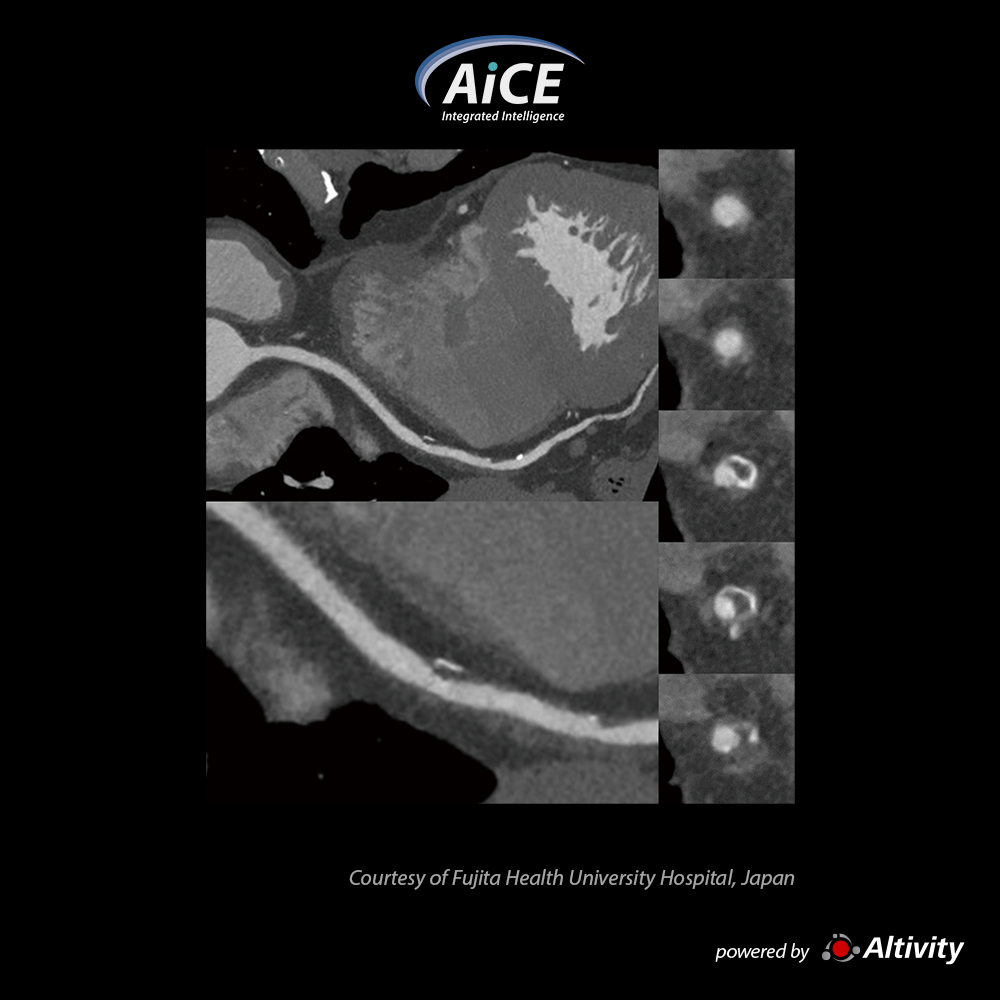 Aquilion Precision Cardiac
