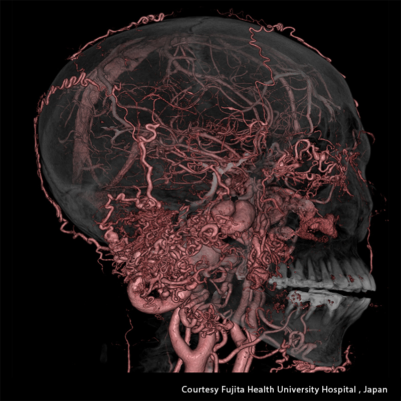 Aquilion Precision Brain
