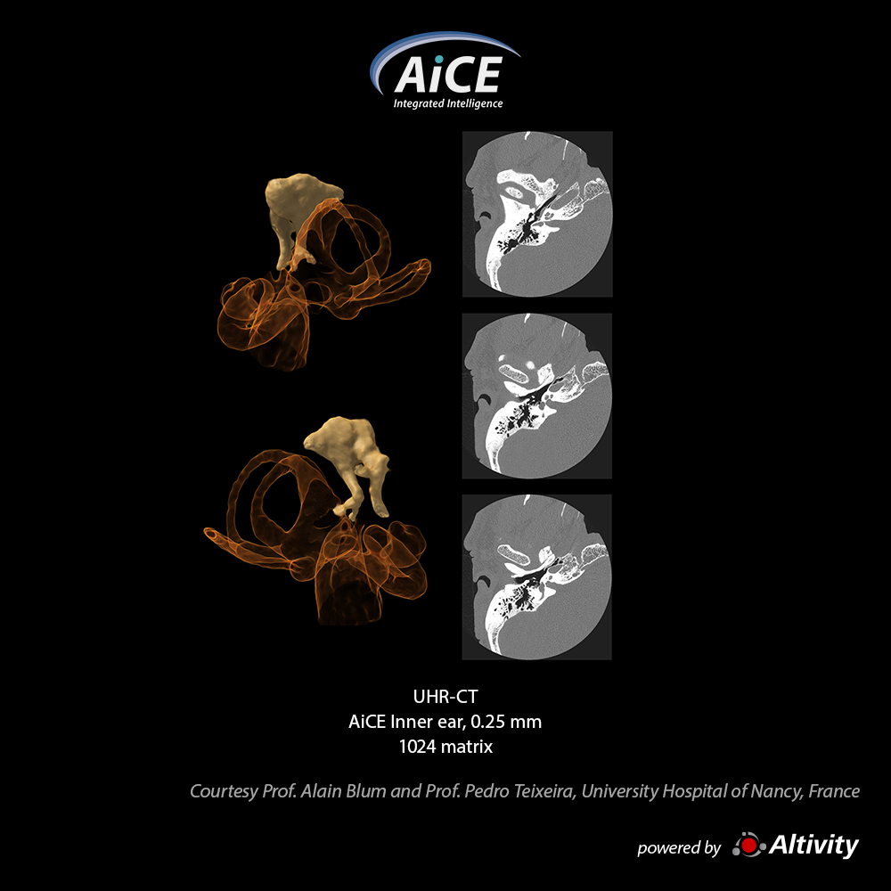 Aquilion Precision Inner-ear